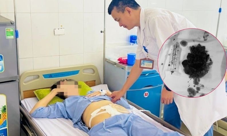 Detox chanh muối tại nhà 6 tháng, người phụ nữ suýt mất mạng vì hoại tử đại tràng
