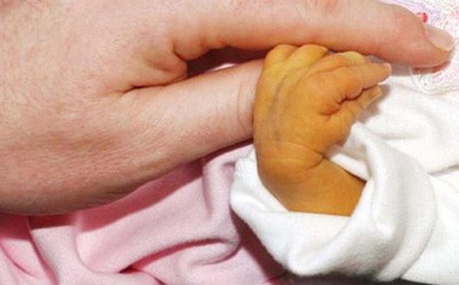 Trẻ sơ sinh bị vàng da: Những điều mẹ cần biết